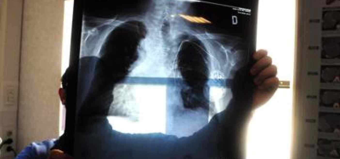 Tumori, in carcinoma polmonare risultati positivi da combinazione in prima linea