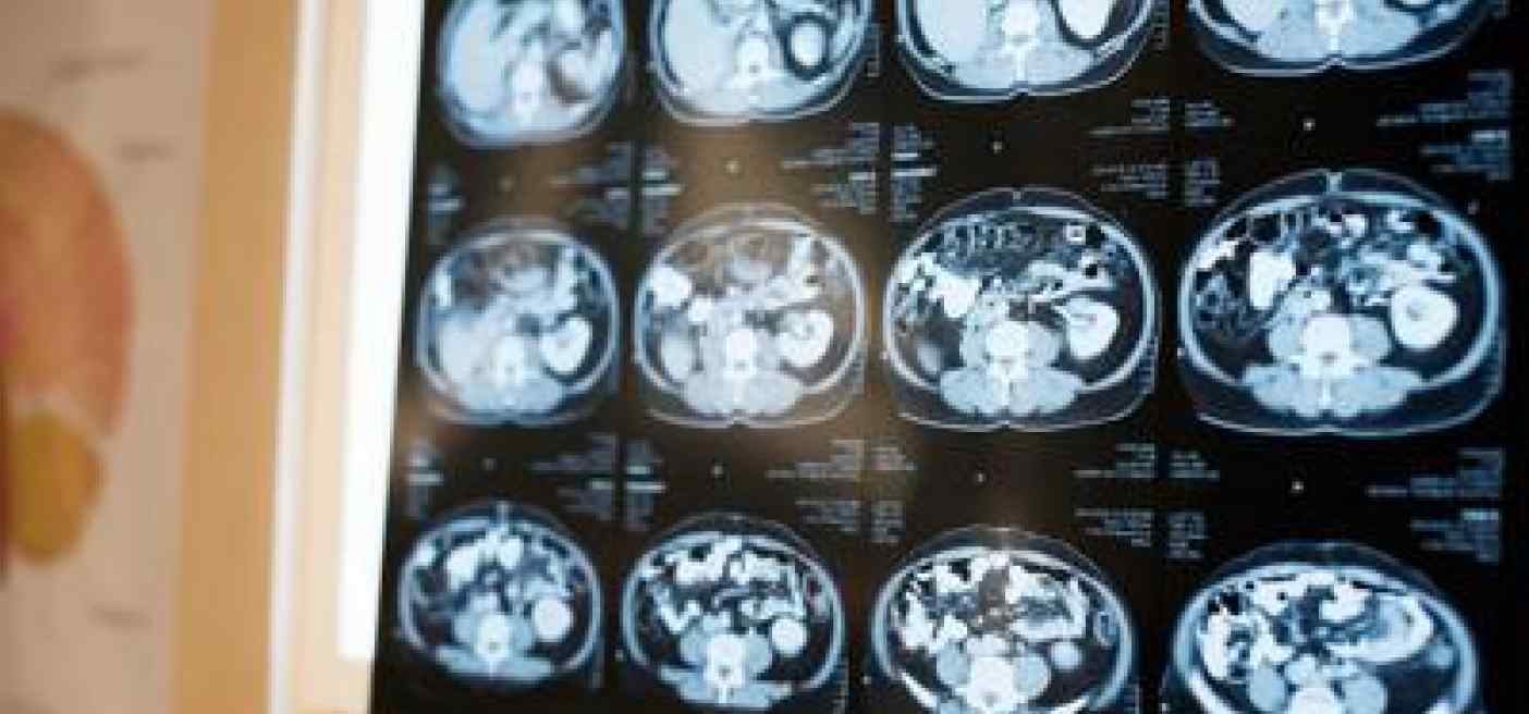 Neurologi: "Noi fondamentali in gestione neoplasie cerebrali"