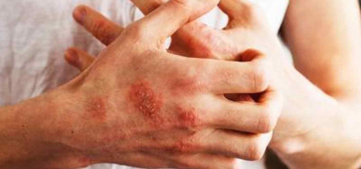 Psoriasi a placche, studio conferma efficacia terapia orale deucravacitinib