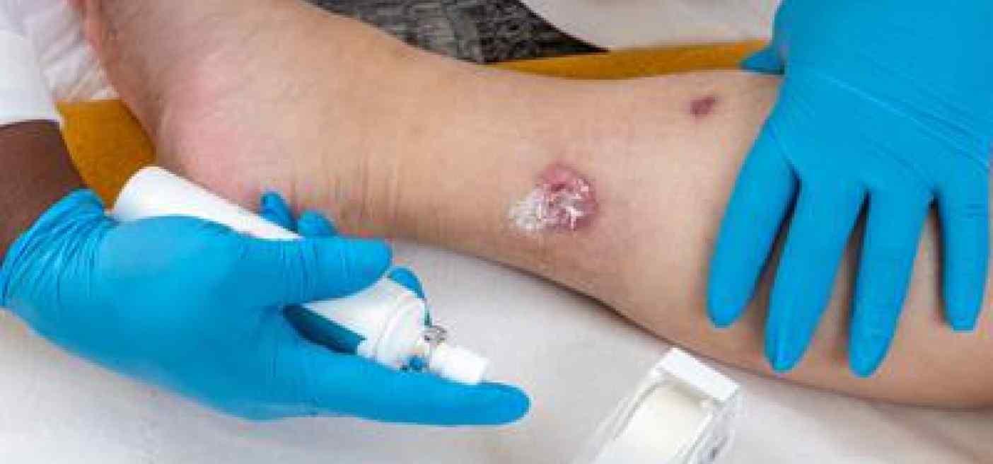 Idrosadenite suppurativa, quando fare la doccia o dormire diventano ostacoli