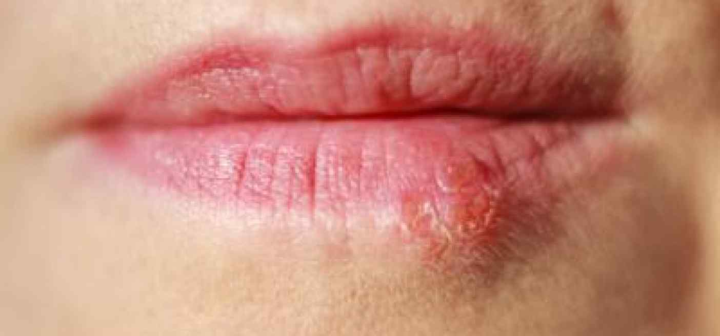 Terapia genica contro herpes labbra, con cura sperimentale -90% virus