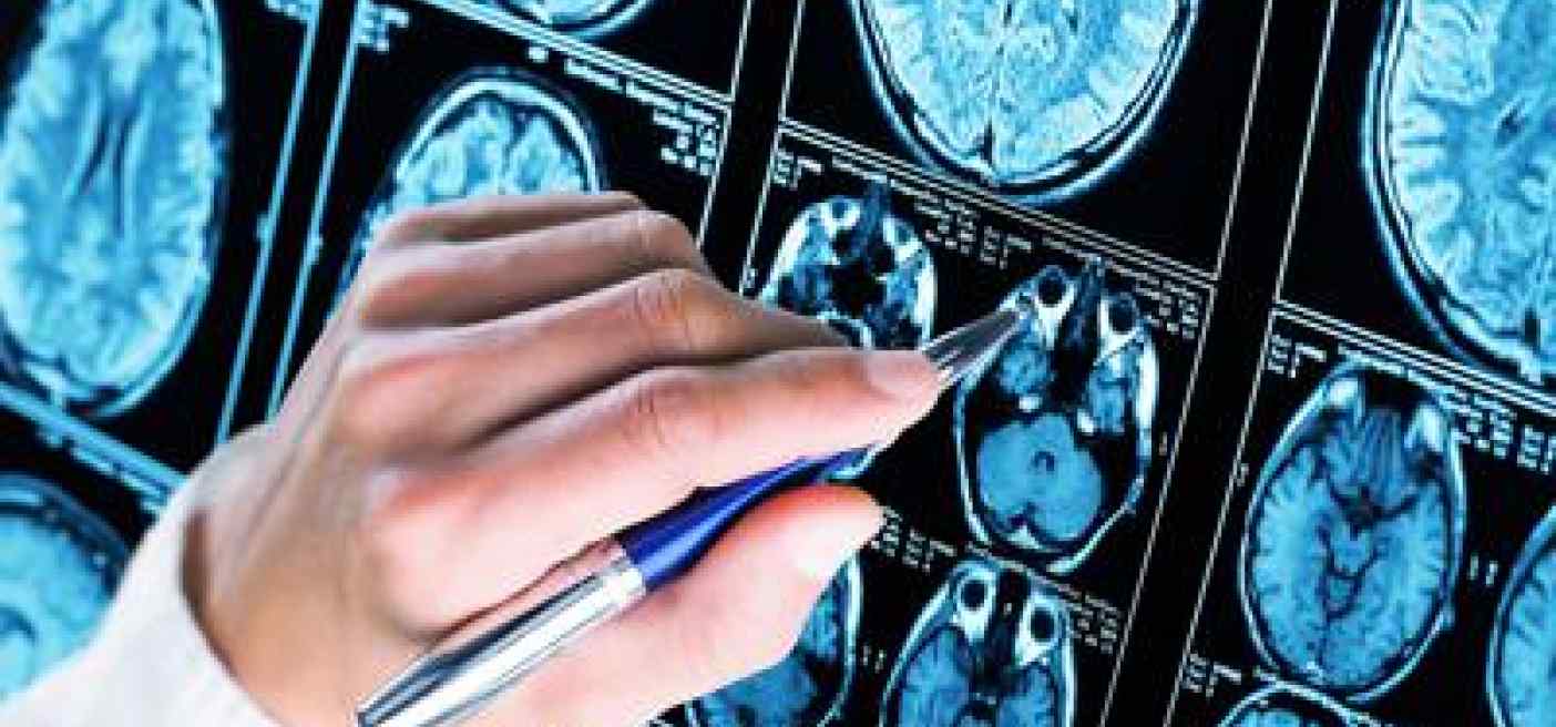 Sin e SinDem: "Sì Ema a lecanemab luce in fondo al tunnel per Alzheimer"