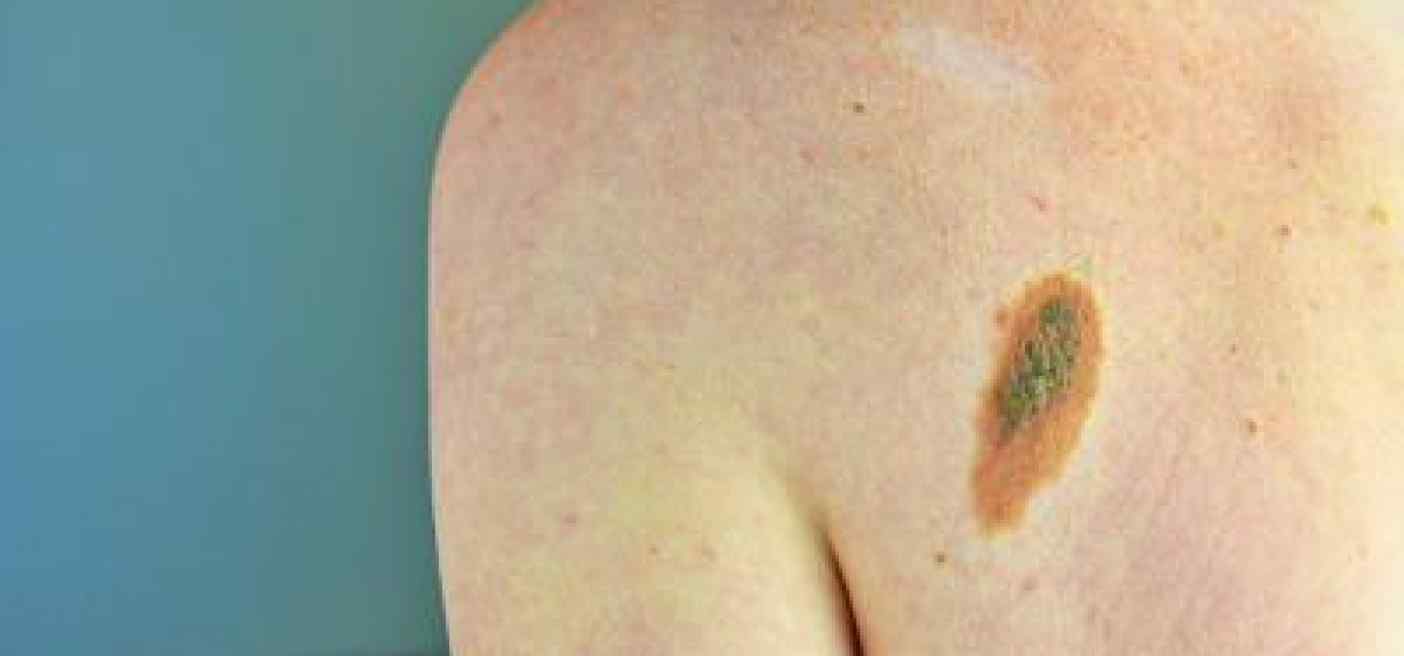 Ok Aifa a immunoterapia in fase precoce per melanoma e carcinoma polmonare