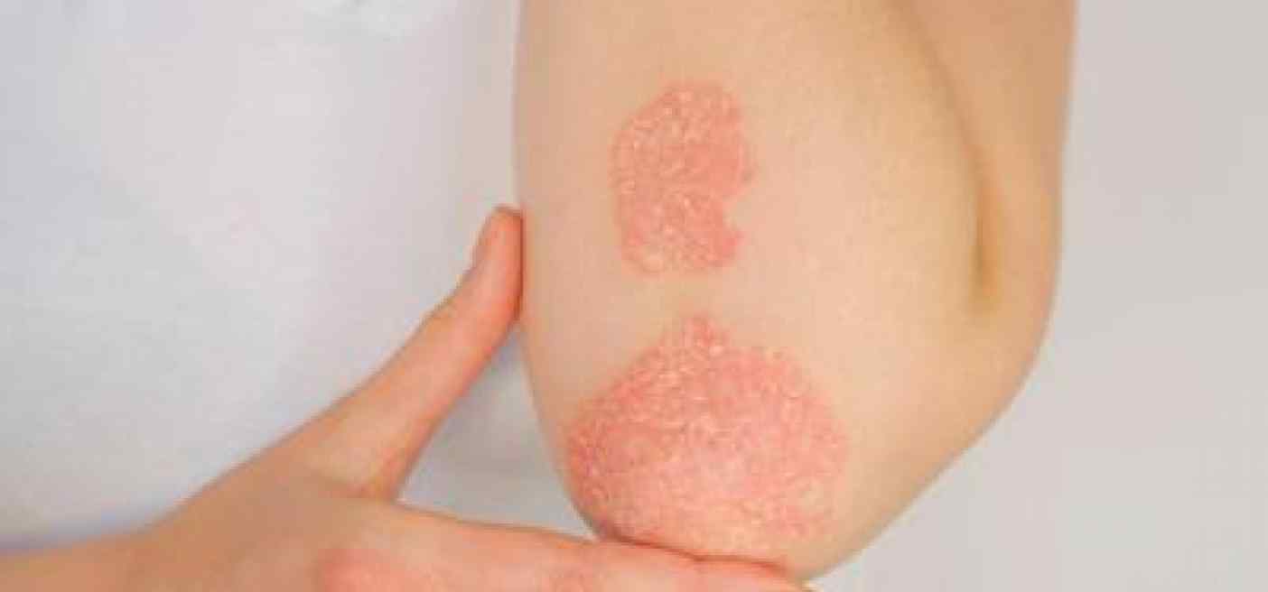Giornata psoriasi, Consulcesi in supporto di operatori e pazienti