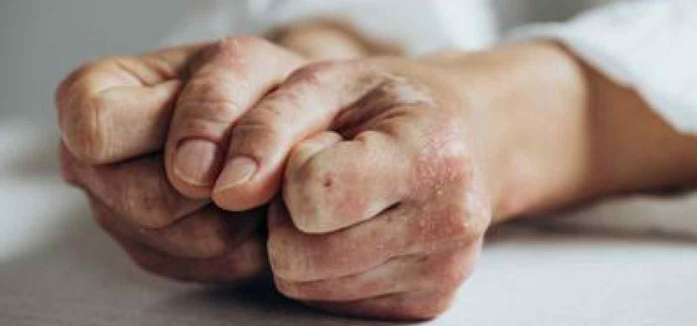 Lo studio, inibitore Il-23 riduce segni e sintomi artrite psoriasica attiva