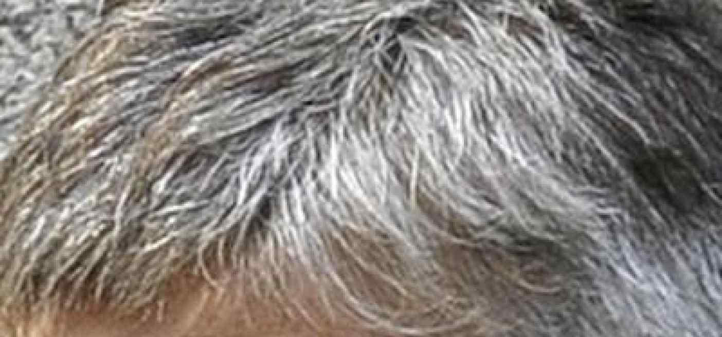 Farmaci: psoriasi cuoio capelluto, nuovi studi confermano efficacia deucravacitinib