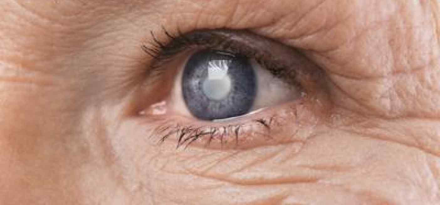 Via cataratta senza operarsi, dal segreto di uno scoiattolo possibile farmaco