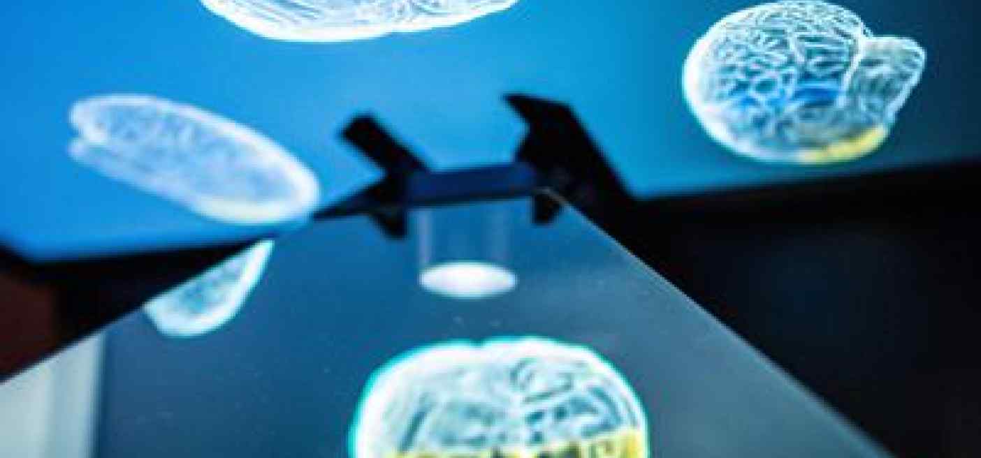 Glioma, tumore cresce con attività cervello: speranza da nuovo studio