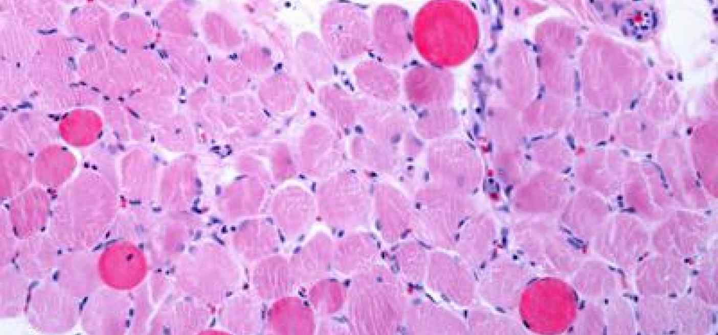 Ricerca, da Telethon una piattaforma per la distrofia di Duchenne