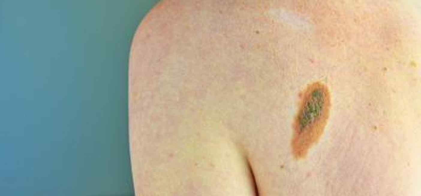 L'oncologo Ascierto: "Aumentano casi melanoma, lampade abbronzanti come fumo"