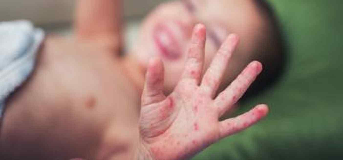 Unicef, +3.000% casi morbillo nel 2023 in Europa e Asia Centrale
