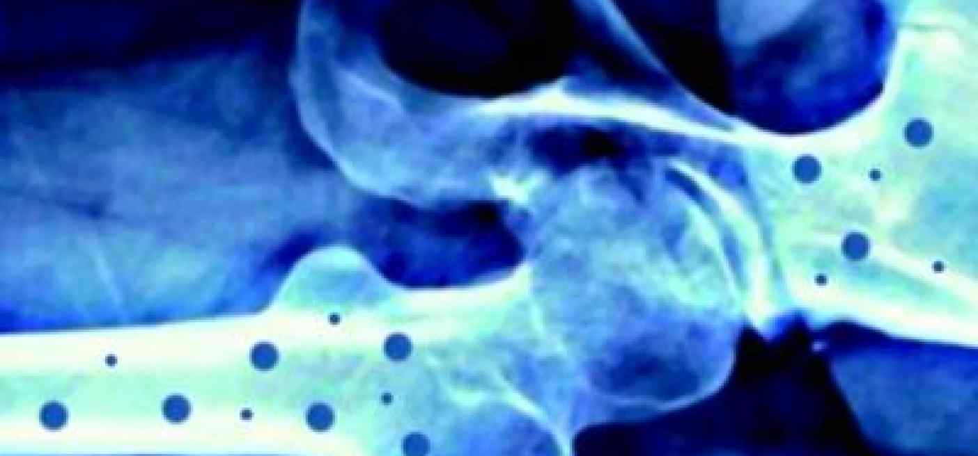 Il 20 ottobre 'Giornata mondiale dell’osteoporosi'
