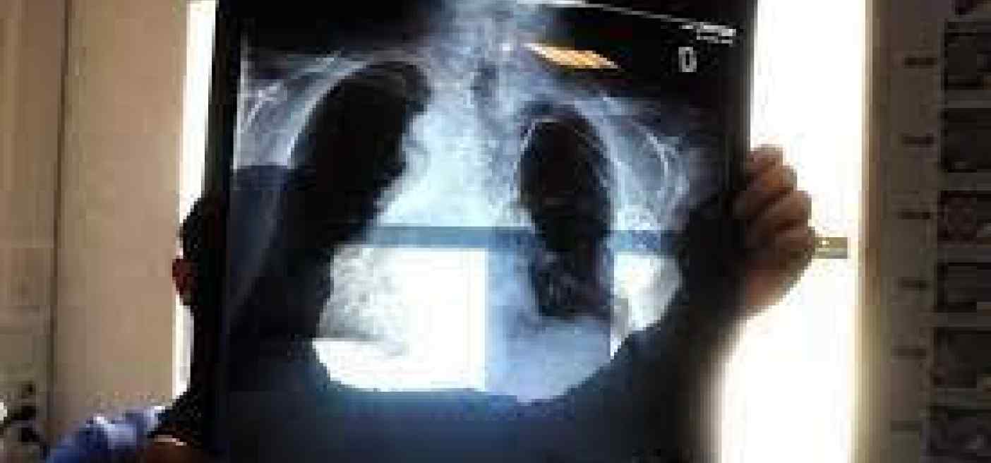 Tumori, Piattaforma polmone per cure personalizzate e diagnosi precoce