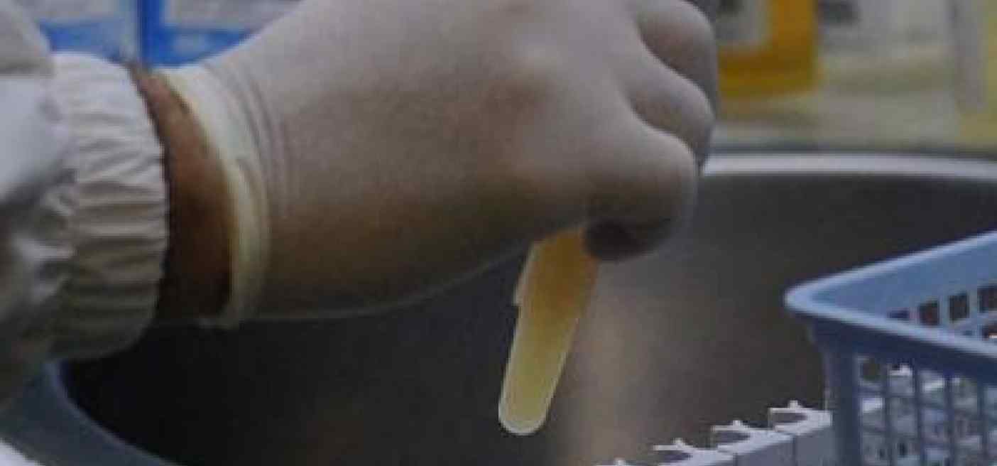 Pancreas, scoperta impronta digitale molecolare delle lesioni che annunciano tumori