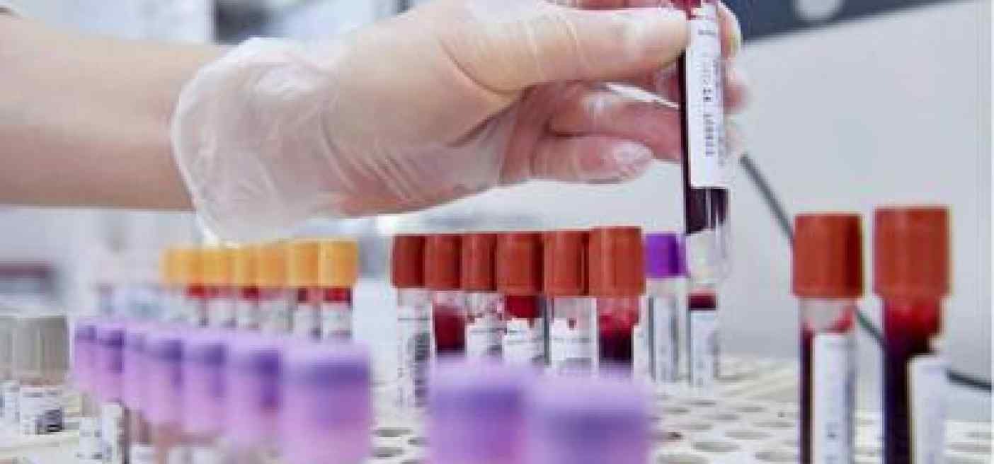 Tumore alla prostata, novità nelle terapie dei casi più gravi