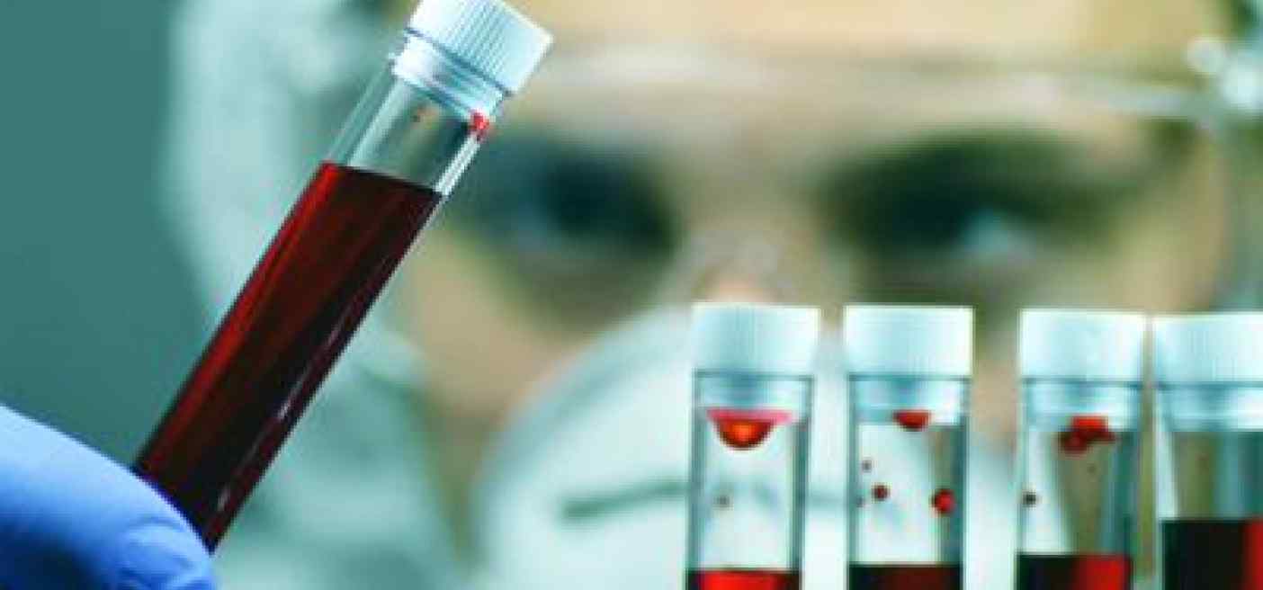 Tumori, Ue approva terapia per adulti con leucemia linfatica cronica refrattaria
