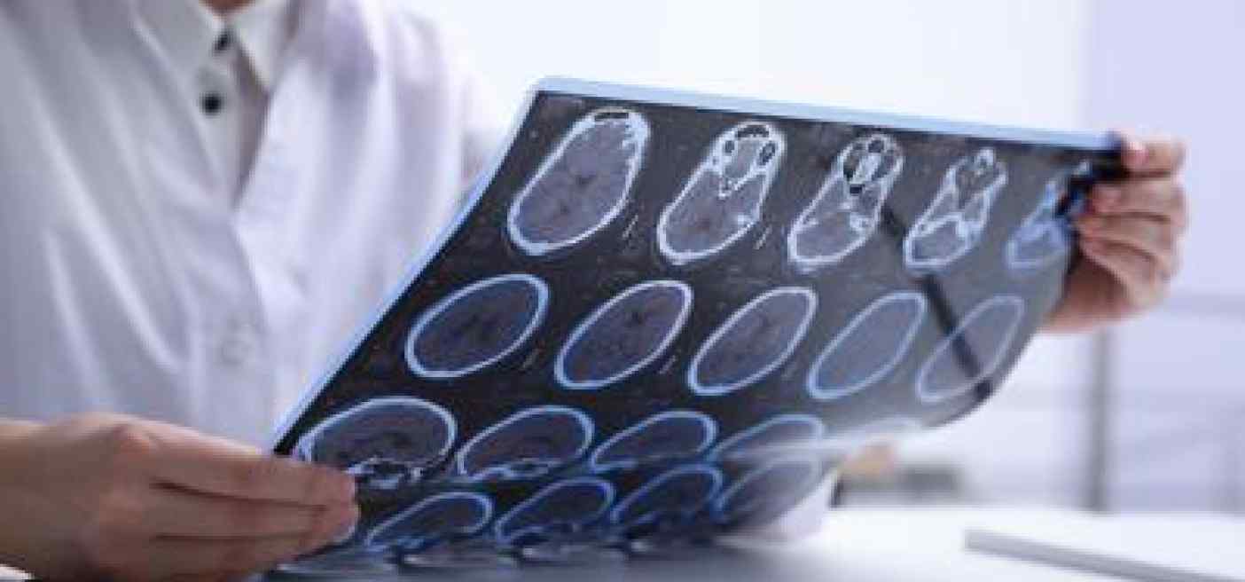 Sclerosi multipla, nuovi dati confermano efficacia cladribina a 4 anni