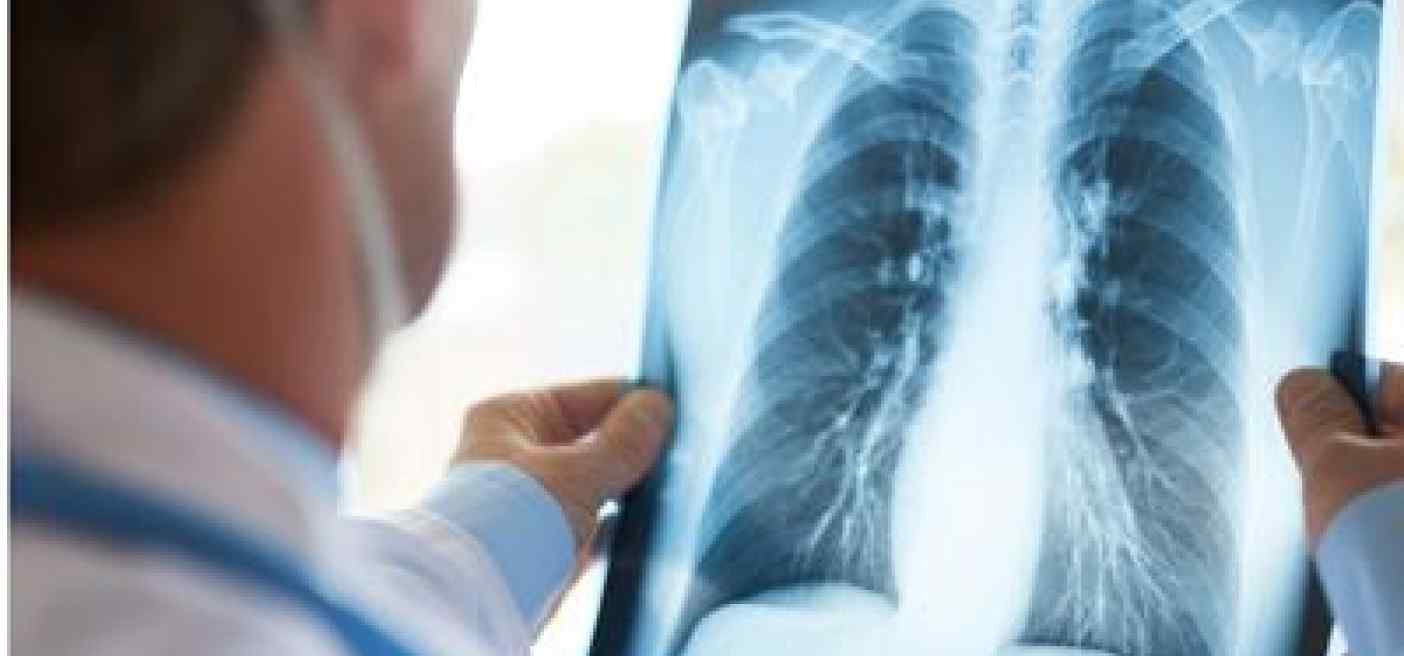 Cancro polmone, firma molecolare predice efficacia immunoterapia